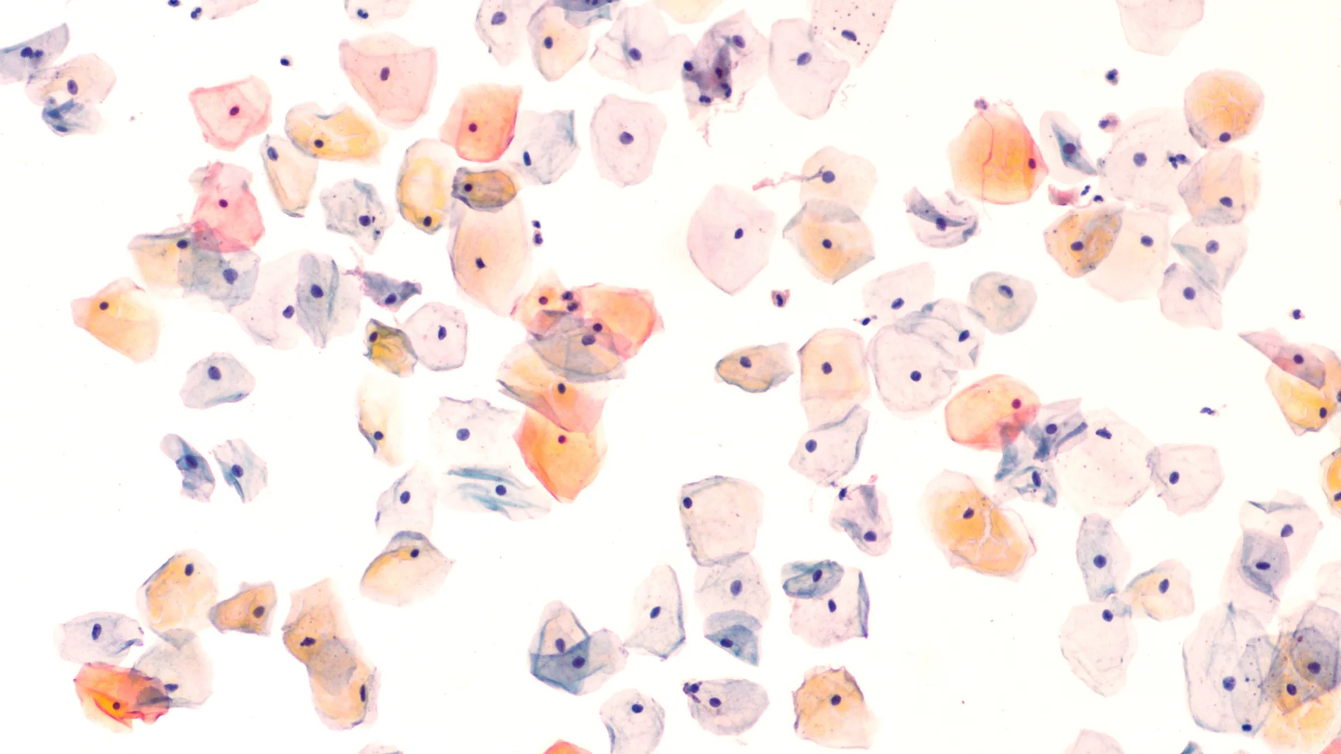 Condylomas